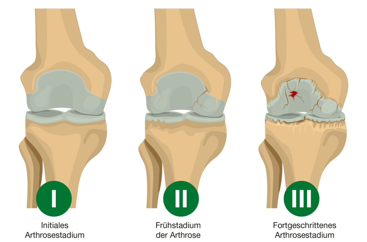 Arthrose – Was Tun Bei Gelenkschmerzen? Dr. Böhm® Ratgeber